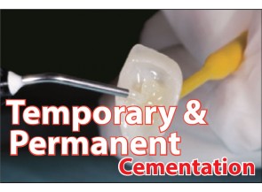 Temporary & Permanent Cementation
